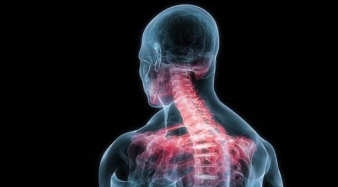 Неврит затылка