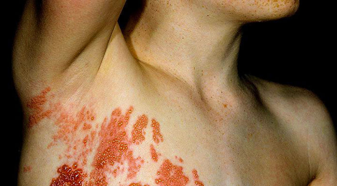 Тифлит кишечника: что это такое и почему это важно знать герпетическая сыпь