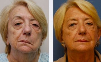 Что происходит с лицом при инсульте