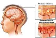 Инфекционный менингит