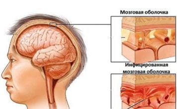Инфекционный менингит Инфекционный менингит