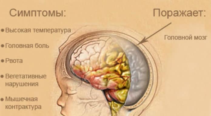 Менингит симптомы у подростков