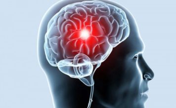 Лакунарный инсульт головного мозга: что это такое и насколько он опасен