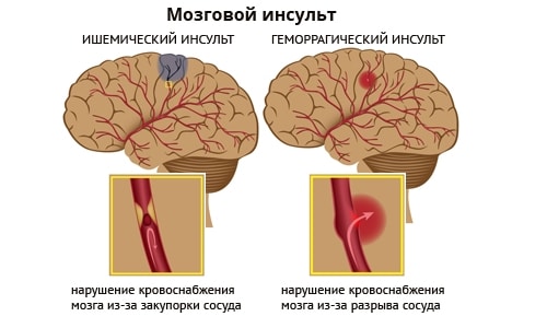 Отличие ишемического и геморрагического инсультов.