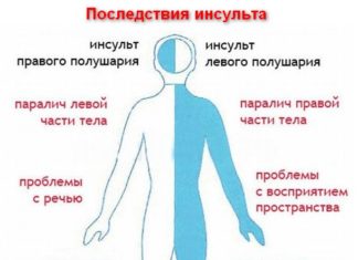 Дивертикулез сигмовидной кишки: что это и как с этим бороться