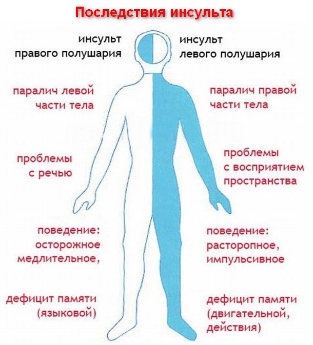 Наглядная схема последствий инсульта