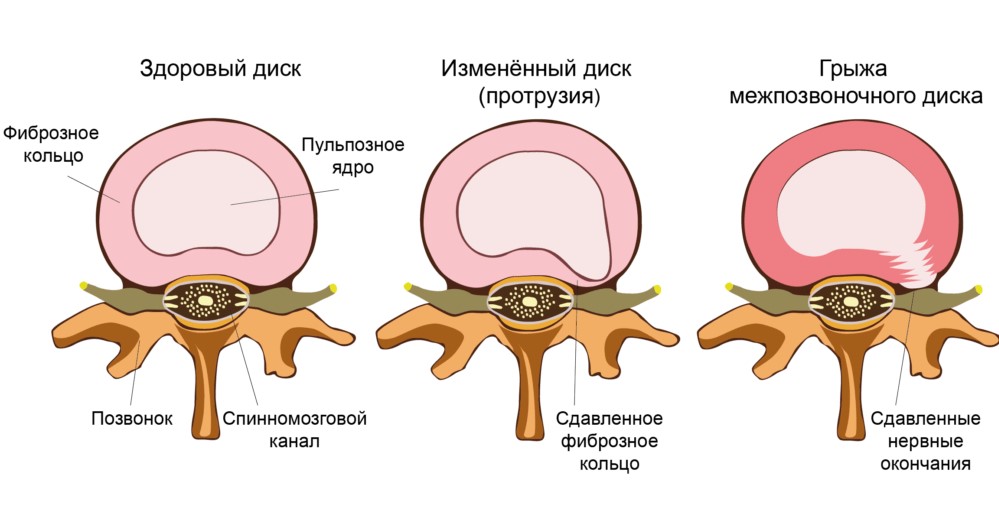 Межпозвоночная грыжа вызывает ишиас