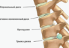Грыжа позвоночника