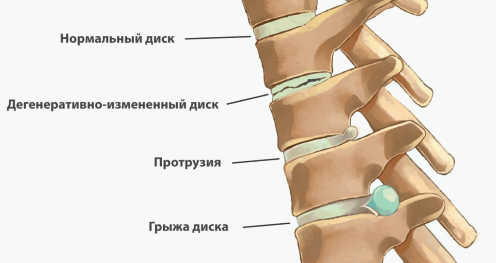 Грыжа позвоночника