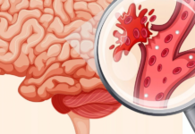Геморрагический инсульт - что это такое?