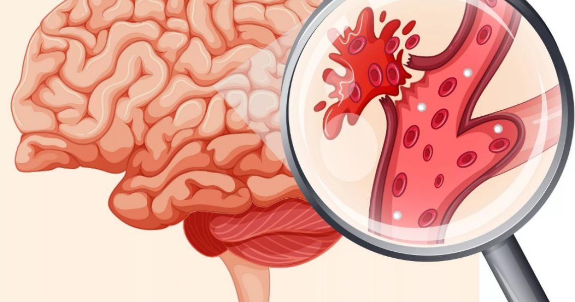 Геморрагический инсульт - что это такое?