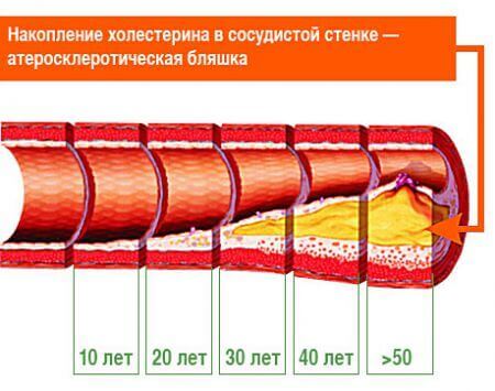 Атеросклероз - развитие с возрастом