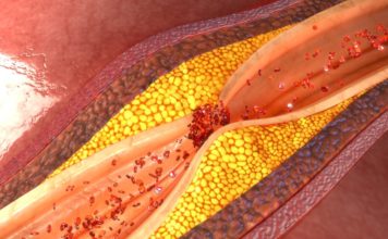 Атеросклероз, чем опасен?