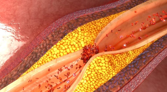 Атеросклероз, чем опасен?
