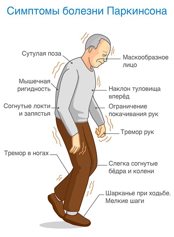 Как выглядит и проявляется болезнь Паркинсона