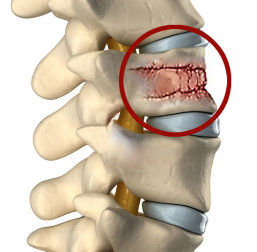 Перелом позвоночника при остеопорозе