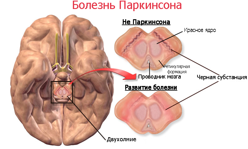 Мозг при болезни Паркинсона