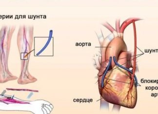 Диффузные изменения легких: что это такое и как с этим жить? Аортокоронарное шунтирование: как проходит операция
