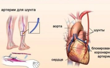 Аортокоронарное шунтирование: как проходит операция