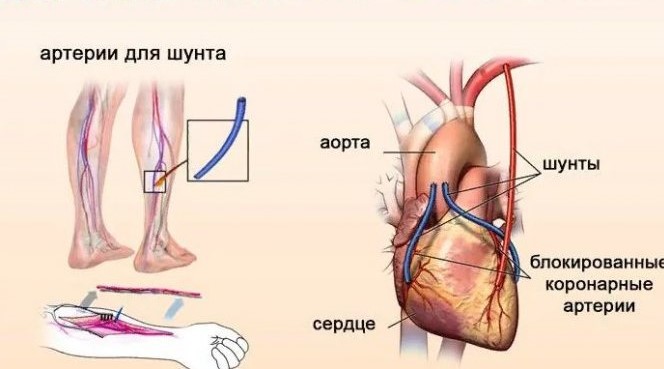 Аортокоронарное шунтирование: как проходит операция