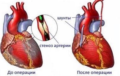 Аортокоронарное шунтирование- кому показана операция