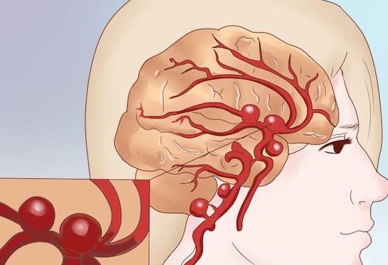 Субарахноидальное кровоизлияние: что это такое, какие признаки и причины, диагностика и лечение Субарахноидальное кровоизлияние: как определить и лечить, первая помощь