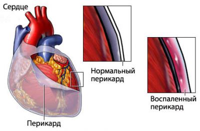 Перикардит- причины заболевания