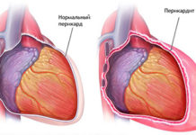 Перикардит - симптомы
