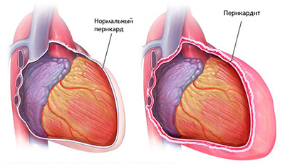 Перикардит - симптомы