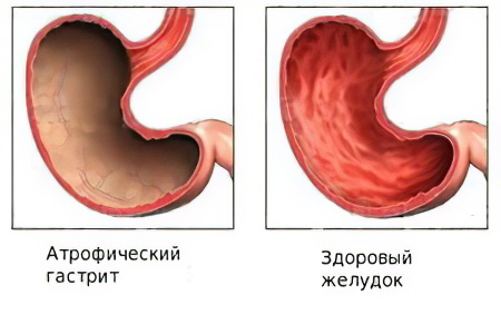 Атрофический гастрит - что это такое?