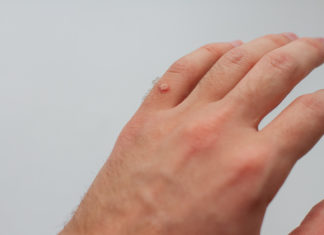 Чем опасны вирусные бородавки