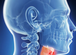 рак горла - симптомы и лечение