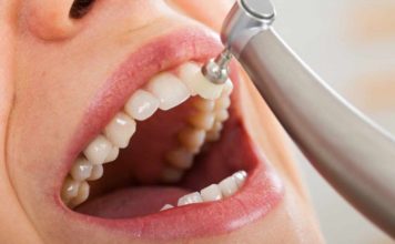 Удаление зубного камня