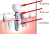 Имплантация зубов с гарантией