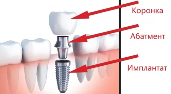 Имплантация зубов с гарантией