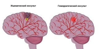 Инсульт - виды