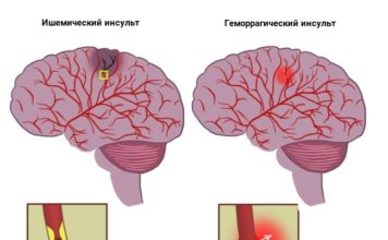 Инсульт: виды, симптомы, лечение и последствия Инсульт - виды