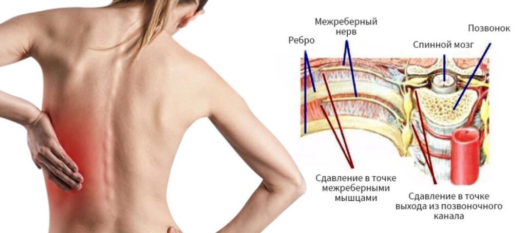 Как отличить межреберную невралгию