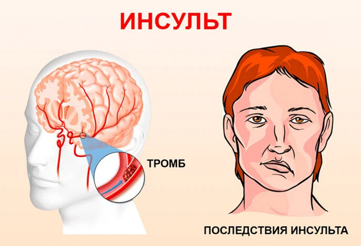 Типы и причины инсульта: обзор исходных факторов и разнообразия инсультов