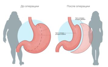 Правосторонний гидроторакс: что это такое и как он влияет на здоровье