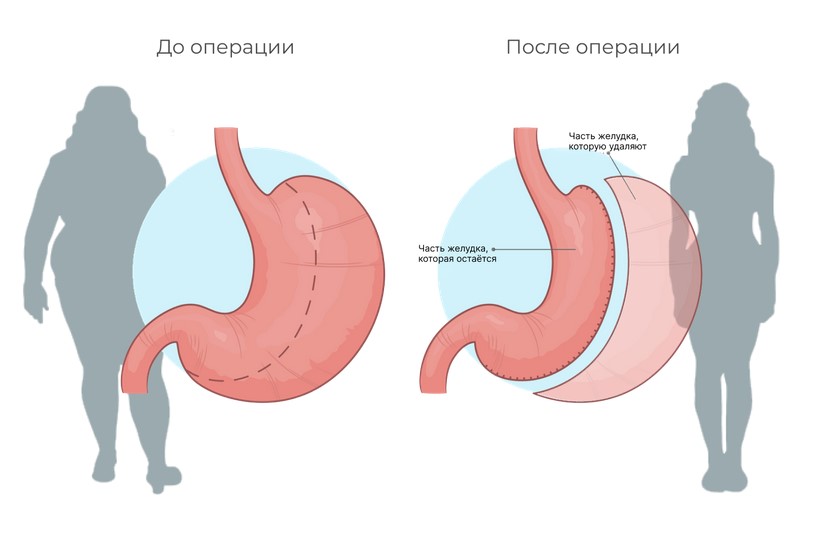 Бариатрические операции: как эффективно побороть ожирение и улучшить здоровье