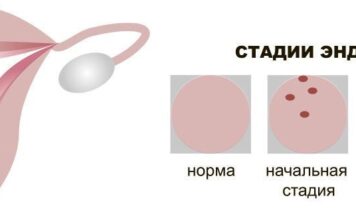 Что такое меланоз толстой кишки при колоноскопии?