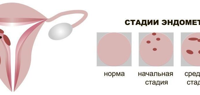 Что такое меланоз толстой кишки при колоноскопии?