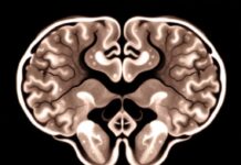 Лечение мультисистемной атрофии: что нужно знать и как справляться с недугом