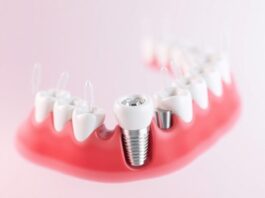 Имплантация зубов: как вернуть улыбку и не потерять покой