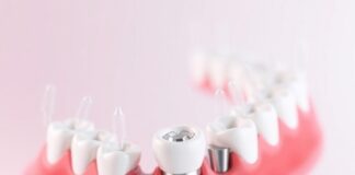 Имплантация зубов: как вернуть улыбку и не потерять покой