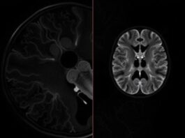 МРТ-ангиография: невидимая карта ваших сосудов, которую может сделать только магнит МРТ-ангиография: невидимая карта ваших сосудов, которую может сделать только магнит