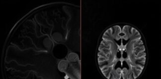 МРТ-ангиография: невидимая карта ваших сосудов, которую может сделать только магнит МРТ-ангиография: невидимая карта ваших сосудов, которую может сделать только магнит